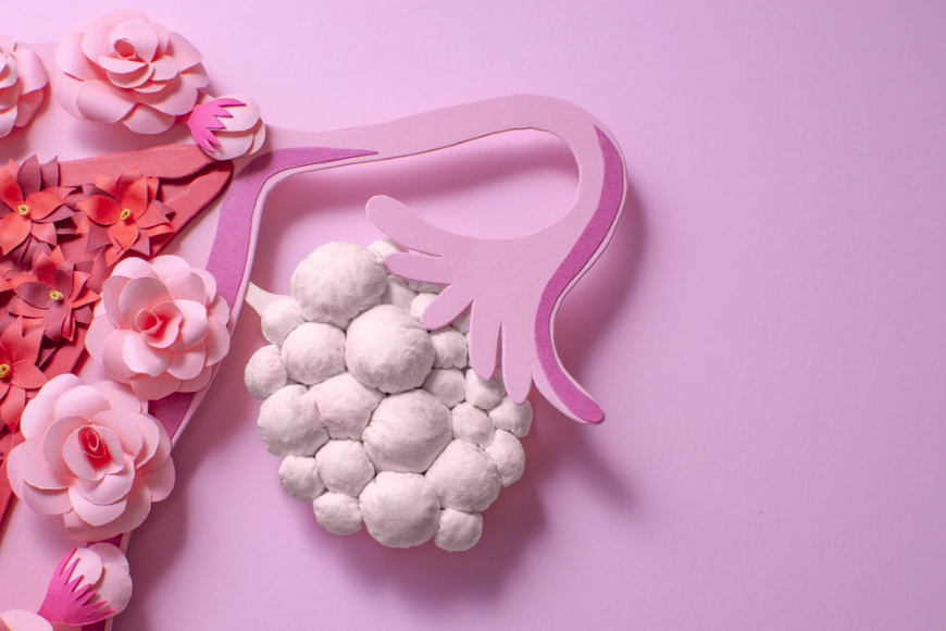 All About PCOS in Dubai: Which PCOS Type Are You? All About PCOS in Dubai: Which PCOS Type Are You?